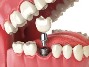 ایمپلنت تک دندان چیست و چه مزایایی دارد؟