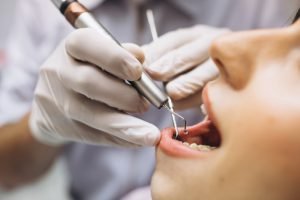 سیلانت‌های دندانی چه هستند و موارد استفاده از آن‎‌ها به چه صورت است؟