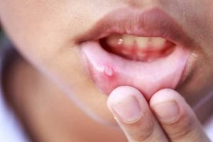 آفت دهان و 5 روش برای اینکه از شر آن خلاص شوید