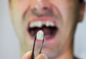 اثرات دندان از دست‌رفته چیست؟