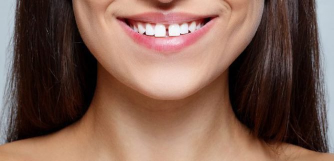 علت فاصله افتادن بین دندان‌ها چیست؟