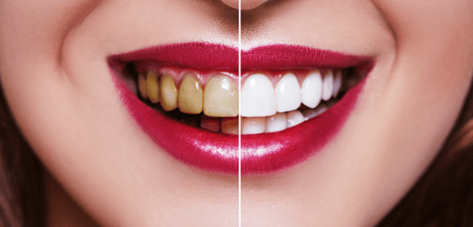تغییر رنگ دندان ها