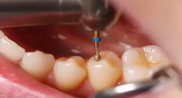 دستورالعمل مراقبت از دندان بعد از پر کردن